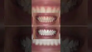 Come avere i Denti Bianchi grazie alle Strisce Sbiancanti