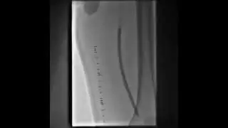 Subintimal Re-Entry with Nitinol Stents