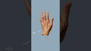 Aging Hand Rejuvenation 🖐🏽 #dermatologist #skincare