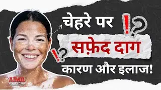 चेहरे पर सफ़ेद दाग क्यों होते हैं और अब क्या करें? | Vitiligo on Face