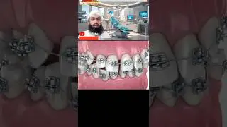 Danto Ko Andar Karne Ka Tarika|Dant M Taar Lagana Price|Teeth Braces|Danto K Bich Ka Gap|Orthodontic