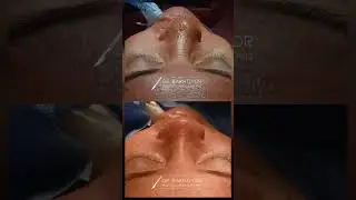 +998772108844 +998917895010 #rhinoplasty #rinoplastika #burun #nosejob #ринопластика ##пластиканоса