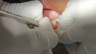 &ldquo;The Flap Recap: Saving Bone, Restoring Tone&rdquo; #bonedisease #gumsurgery #oralcare #painlesssurgery