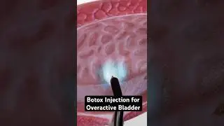 Botox for bladder control (3D Animation)