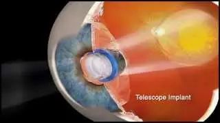 Retinal Consultants of Arizona Presents - the CentraSight Implantable Telescope