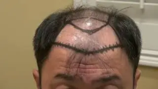 Advance Bald Hair Loss Surgery Treatment Hair Transplant Restoration Diep http://www.mhtaclinic.com