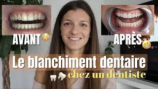 BLANCHIMENT DENTAIRE chez le dentiste (prix, dur&eacute;e, sensibilit&eacute;...)
