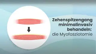 Zehenspitzengang bei Kindern: Sanfte OP-Methode erklärt (Myofasziotomie)