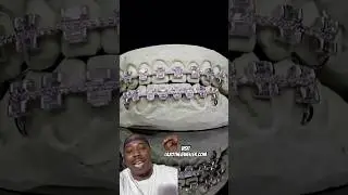 JOHNNY DANG THE WORLD&rsquo;S FIRST ICED OUT PAIR OF BRACES GRILL WITH EMERALD CUT DIAMONDS