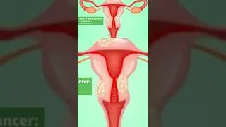 गर्भाशयाचा कॅन्सर: एक महत्त्वाची माहिती #cancer #uterinecancer #endometrium #vdprashant