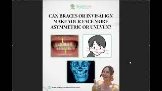 Могут ли брекеты или элайнеры Invisalign вызвать искривление зубов или прикуса или сделать их аси...