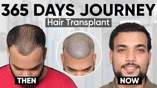 Hair Transplant in Hyderabad (SKTR) | Best Results & Cost of Hair Transplant in Hyderabad |