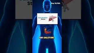 ✅ Day 10 - Gutman's 100 Day Challenge | Dr Pal