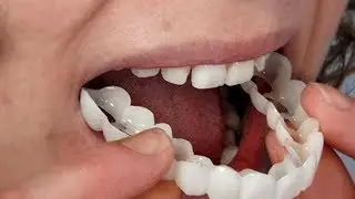 Snap-On Smile,&nbsp;Купить, Съемные Виниры