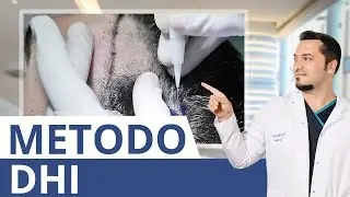 Cos’è il trapianto di capelli DHI? Il dottor Balwi spiega!