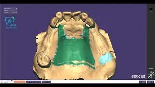 Oral scan file design    Upper partial frame