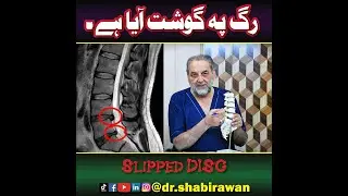 Slipped Disc Explained | Meat Pressing on Nerve | Dr. Shabir Awan | Spine & Orthopedic Specialist