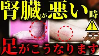 【超意外】絶対に知らないと後悔する腎臓が悪い時の「足」の危険サイン。むずむず.かゆみ.湿疹..意外な兆候とは？「痛風」は実は腎機能低下のサインだった？危険なむくみの見分け方とは？医師が完全解説。