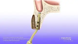 PIEZOSURGERY&reg; - Upper first premolar extraction and endoalveolar implant site preparation procedure
