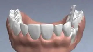Encinitas CA Periodontist Shares Video Animation of a Single Tooth Replacement Dental Implant