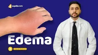 Edema | Medicine | Surgery | Student Online Lecture | Clinical Education | V-Learning