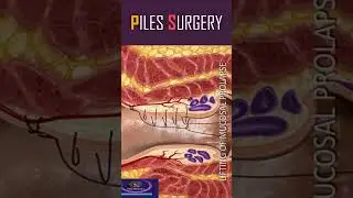 Hemorrhoid Piles Surgery #shorts