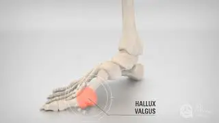 Treating Hallux Valgus using Vancouver Orthotics by Dr  Michael Horowitz | 604 737 3668