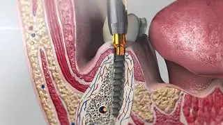 Implant Compressive. Protocol.