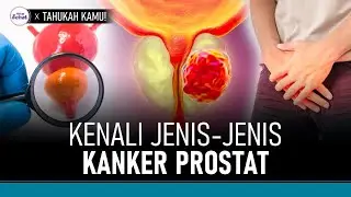 3 Jenis Kanker Prostat yang Perlu Diwaspadai Pria | Hidup Sehat tvOne