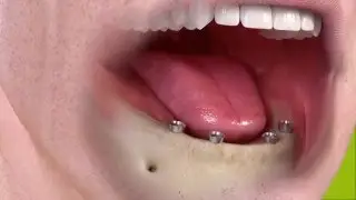 Straumann