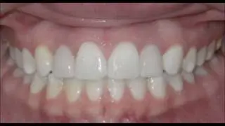 Missing lateral incisors