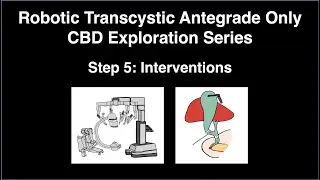 Step 5: Antegrade Interventions - Robotic CBD Exploration Series