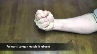 Thompson's Test for Palmaris Longus (CR)