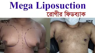 Grade 3 Gynecomastia surgery | Mega Liposuction surgery | Male breast reduction surgery