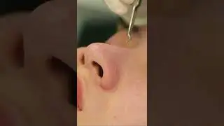 ASMR| Chăm s&oacute;c da - lấy nh&acirc;n mụn chuẩn Spa| ASMR beauty spa relaxing