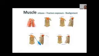 ESA 21 odontoid fracture