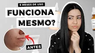 Produtos THE ORDINARY para PELE OLEOSA Funcionam Mesmo? RESENHA