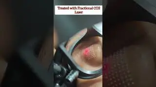 Open Pores on Nose Fractional CO2 Laser Treatment #openporestreatment #openporesremedy #co2laser