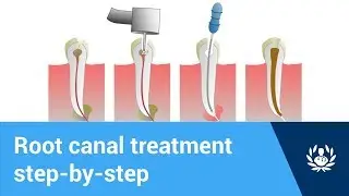 What are the steps of root canal treatment?
