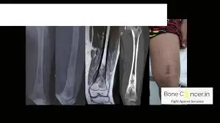 Bone Cancer (Osteosarcoma Femur): Limb Salvage Surgery-Tumor Megaprosthesis, Dr Srimanth B S