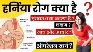 Hernia kya hota hai | causes of hernia | हर्निया क्या है | हर्निया का कारण - This lecture explains।