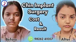 Chin Implant Surgery In Lucknow | Cost Of Chin Implant Surgery in Lucknow | Zenith Clinic 