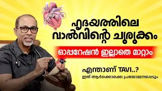 ഹൃദയത്തിലെ വാൽവിൻ്റെ ചുരുക്കം ഓപ്പറേഷൻ ഇല്ലാതെ മാറ്റാം | Dr. Deepak Davidson | TAVI MALAYALAM