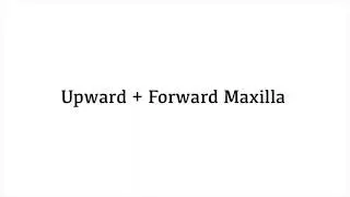 Upward Projected + Forward Grown Maxilla (Subliminal)