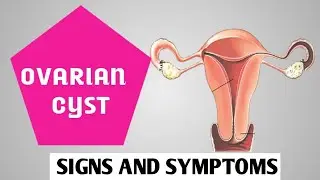 Ovarian Cyst: Signs & Symptoms of Ovarian Cyst // Pharmacist Rubby