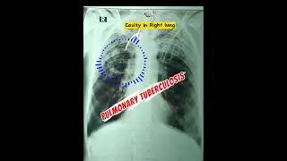 OPD Clicks 100+ Cavity Tuberculosis #clinical #radiology  #mbbs #nurse #foryou #viralvideo #doctor
