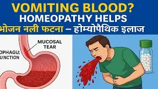 Mallory Weiss Tear | Vomiting with Blood & Homeopathy | भोजन नली-आमाशय फटना इलाज