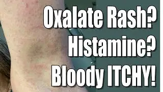 Oxalate Dumping Skin Rash? Histamine? Connections Between Oxalate, Histamine, Mold & Pyroluria