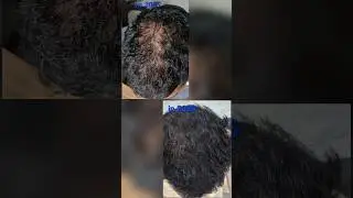 hairgrowth 🤫 #haircare #minoxidil #hairlossprevention #hairtok