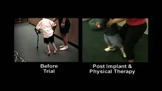 Dr. Georgios Matis - Neuromodulation - Cerebral palsy before & after intrathecal baclofen therapy